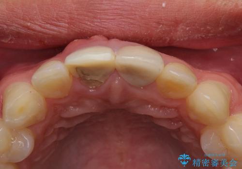 前歯が折れた　歯肉移植を用いた前歯のブリッジの治療前