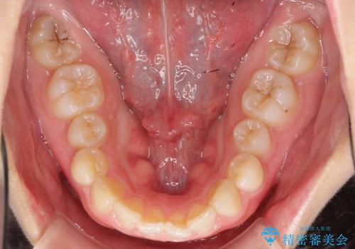 クラウンレングスニング　歯ぐきに埋まっている奥歯への歯周外科処置　インビザライン治療の前処置の治療前