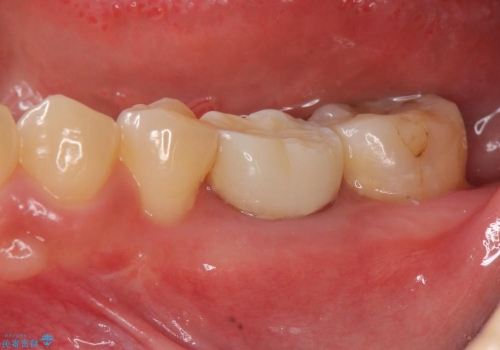 クラウンレングスニング　歯の高径が不足　インビザライン治療の前処置(歯周外科処置)の治療後