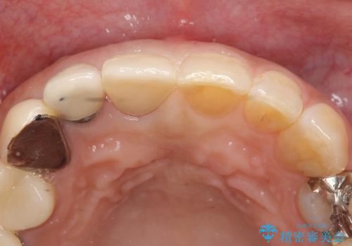 高強度セラミッククラウンによる前歯の補綴治療の治療後