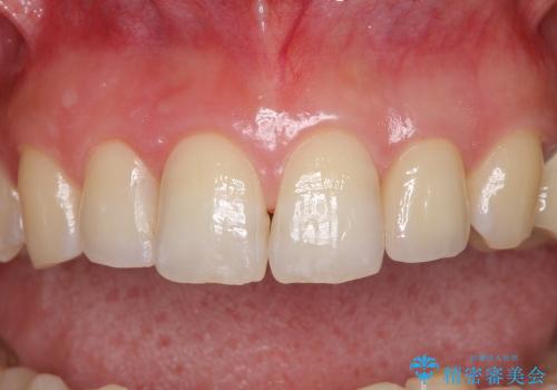 前歯の審美治療　オールセラミックと部分矯正の治療後