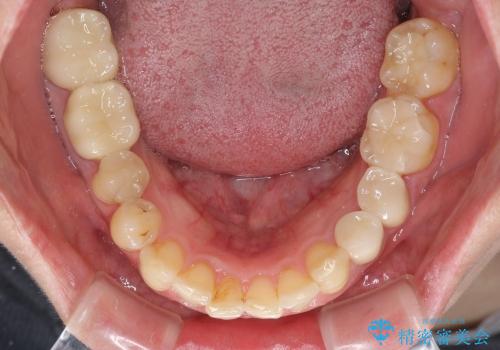 全顎虫歯治療　セラミックで白い歯にの治療後