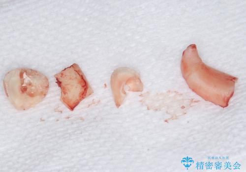 深く埋まっている犬歯を抜歯　10代女子の治療後