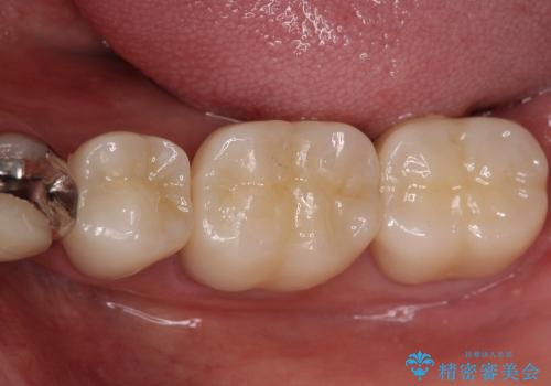 奥歯をセラミックに　銀歯の中の虫歯治療の治療後