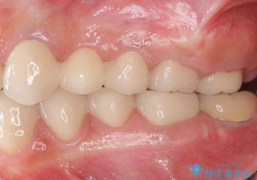 生まれつき歯が黒い　テトラサイクリン歯　40代女性の治療後