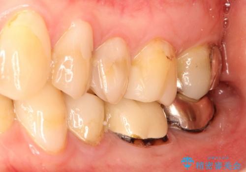 虫歯で欠けた上の奥歯　セラミックブリッジ治療の治療前