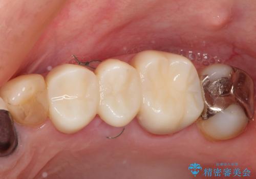 虫歯で欠けた上の奥歯　セラミックブリッジ治療の治療前