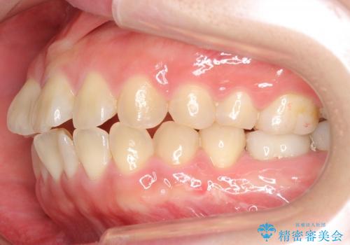クラウンレングスニング　歯の高径が不足　インビザライン治療の前処置(歯周外科処置)の治療後