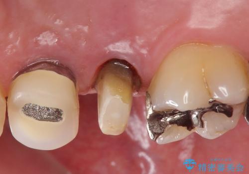 根管治療済みの歯の補綴の治療中