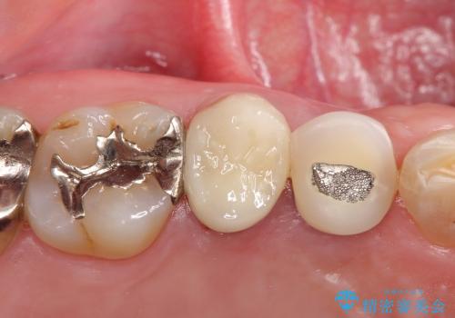 根管治療済みの歯の補綴の治療後