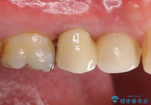 根管治療済みの歯の補綴の治療後