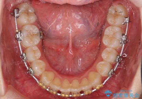 前歯のねじれ　歯を抜かない矯正の治療中