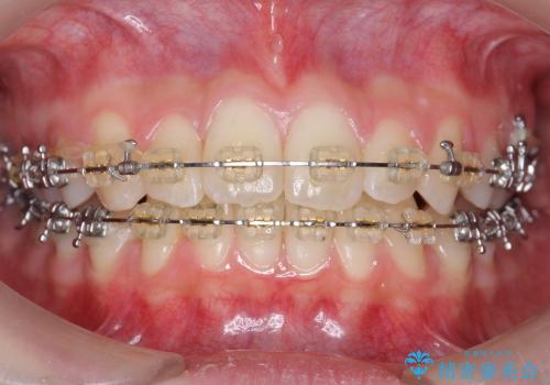 前歯のねじれ　歯を抜かない矯正の治療中