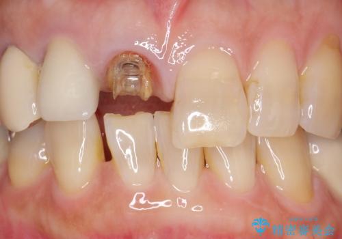 高強度セラミッククラウンによる前歯の補綴治療の治療前