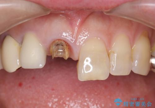 高強度セラミッククラウンによる前歯の補綴治療の治療前