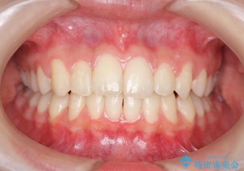 前歯のねじれ　歯を抜かない矯正の治療後