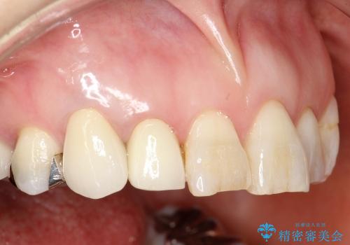 40代女性　前歯の審美修復　土台や根管治療には介入せずの治療後