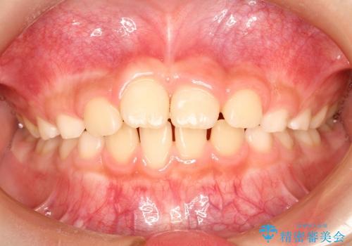 10歳の男の子　前歯の強いねじれをⅠ期治療にて改善するの治療後