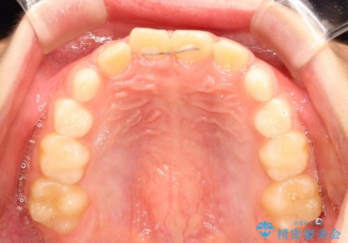 10歳の男の子　前歯の強いねじれをⅠ期治療にて改善するの治療後