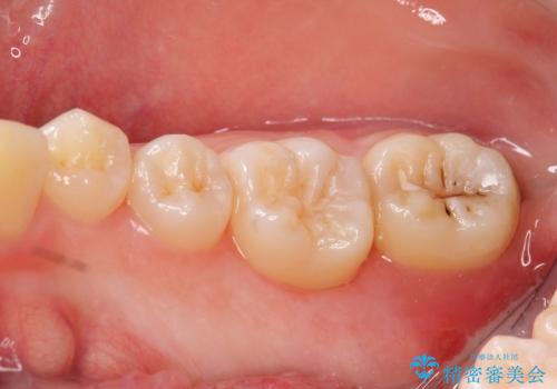 クラウンレングスニング　歯ぐきに埋まっている奥歯への歯周外科処置　インビザライン治療の前処置の治療後