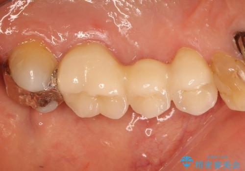 虫歯で欠けた上の奥歯　セラミックブリッジ治療の治療後