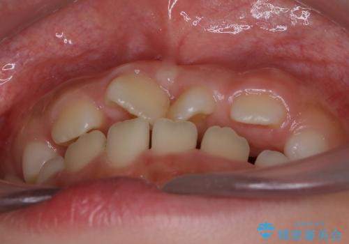 10歳の男の子　前歯の強いねじれをⅠ期治療にて改善するの治療前