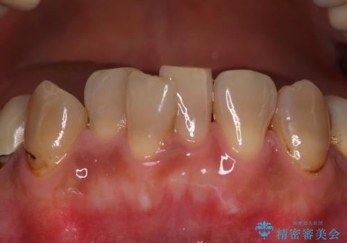生まれつき歯が黒い　テトラサイクリン歯　40代女性の治療前