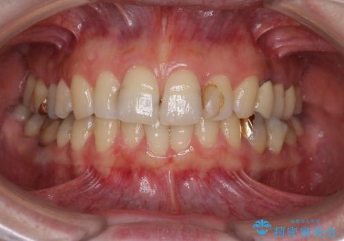 前歯の審美治療　オールセラミックと部分矯正の治療前