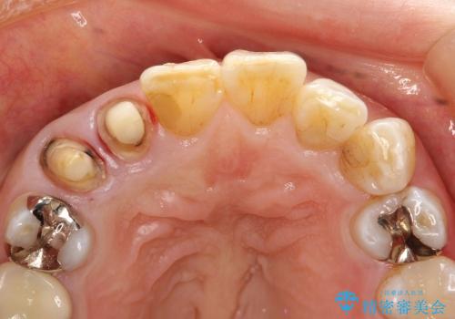 40代女性　前歯の審美修復　土台や根管治療には介入せずの治療中