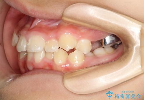 埋もれた奥歯のスペース獲得　小学生のⅠ期治療の治療中