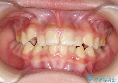 埋もれた奥歯のスペース獲得　小学生のⅠ期治療の治療前