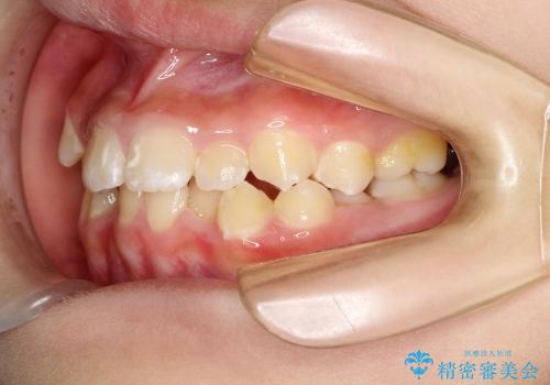 埋もれた奥歯のスペース獲得　小学生のⅠ期治療の治療前