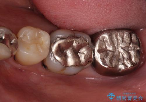 奥歯をセラミックに　銀歯の中の虫歯治療の治療前