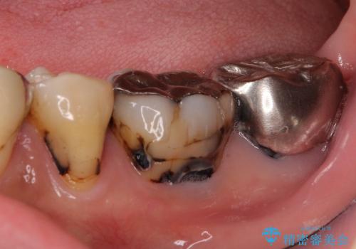 奥歯をセラミックに　銀歯の中の虫歯治療