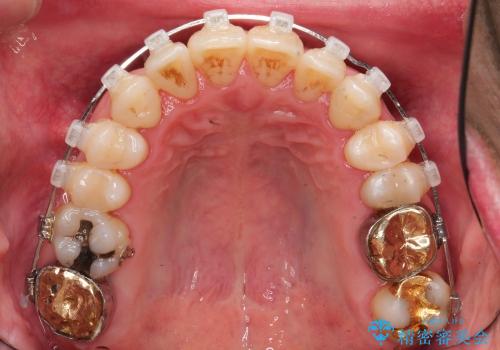 前歯の歯並びの改善　クリアブラケットによる矯正治療　の治療中