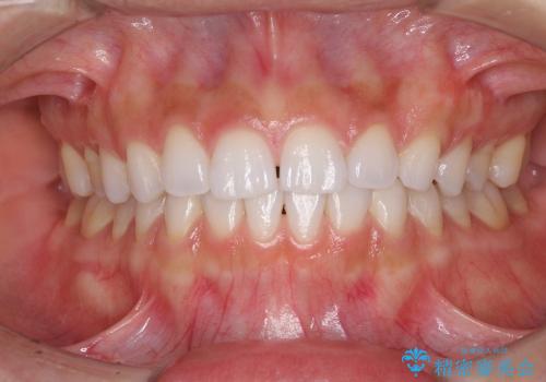 インビザラインとホワイトニング　白い歯ときれいな歯並びの治療後