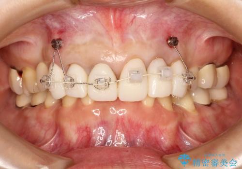 40代女性　歯ぐきのラインをそろえる　部分矯正を用いた前歯の審美修復の治療中
