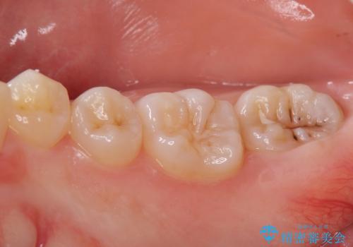 クラウンレングスニング　歯ぐきに埋まっている奥歯への歯周外科処置　インビザライン治療の前処置の治療前