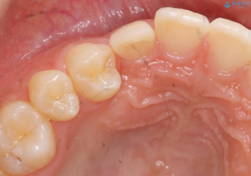深く埋まっている犬歯を抜歯　10代女子の治療前