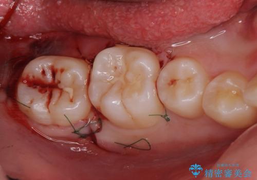クラウンレングスニング　歯ぐきに埋まっている奥歯への歯周外科処置　インビザライン治療の前処置の治療中