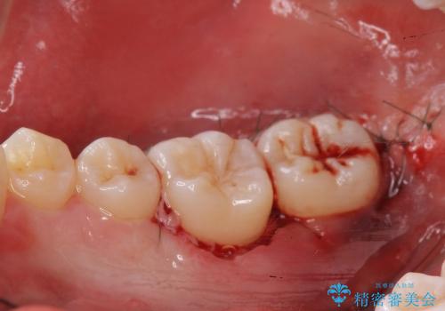 クラウンレングスニング　歯ぐきに埋まっている奥歯への歯周外科処置　インビザライン治療の前処置の治療中