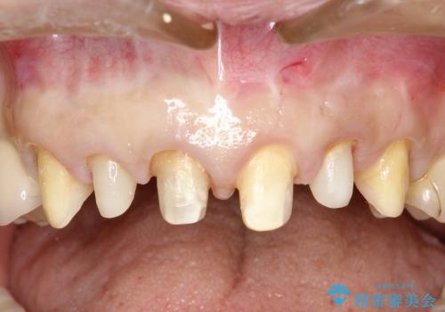 40代女性　歯ぐきのラインをそろえる　部分矯正を用いた前歯の審美修復の治療中