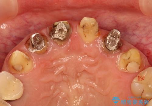 40代女性　歯ぐきのラインをそろえる　部分矯正を用いた前歯の審美修復の治療前