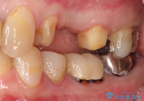 虫歯で欠けた上の奥歯　セラミックブリッジ治療の治療中