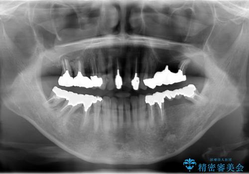 古い金属の治療で奥歯がなくなった方のインプラント、セラミック治療の治療前
