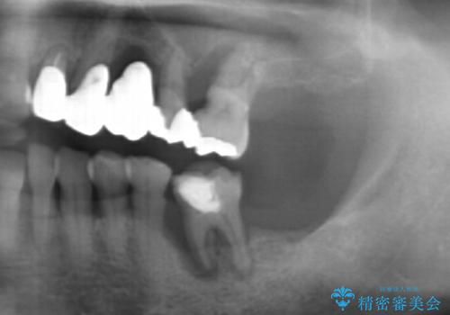 噛み合わせ、前歯を守る 奥歯インプラントの治療前