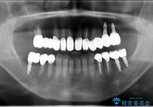 古い金属の治療で奥歯がなくなった方のインプラント、セラミック治療の治療後