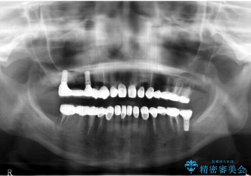 生まれつき歯が黒い　テトラサイクリン歯　40代女性の治療後