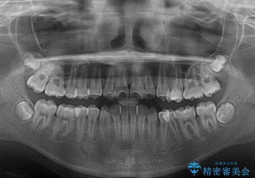 埋もれた奥歯のスペース獲得　小学生のⅠ期治療の治療後