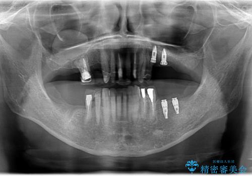 古い金属の治療で奥歯がなくなった方のインプラント、セラミック治療の治療中
